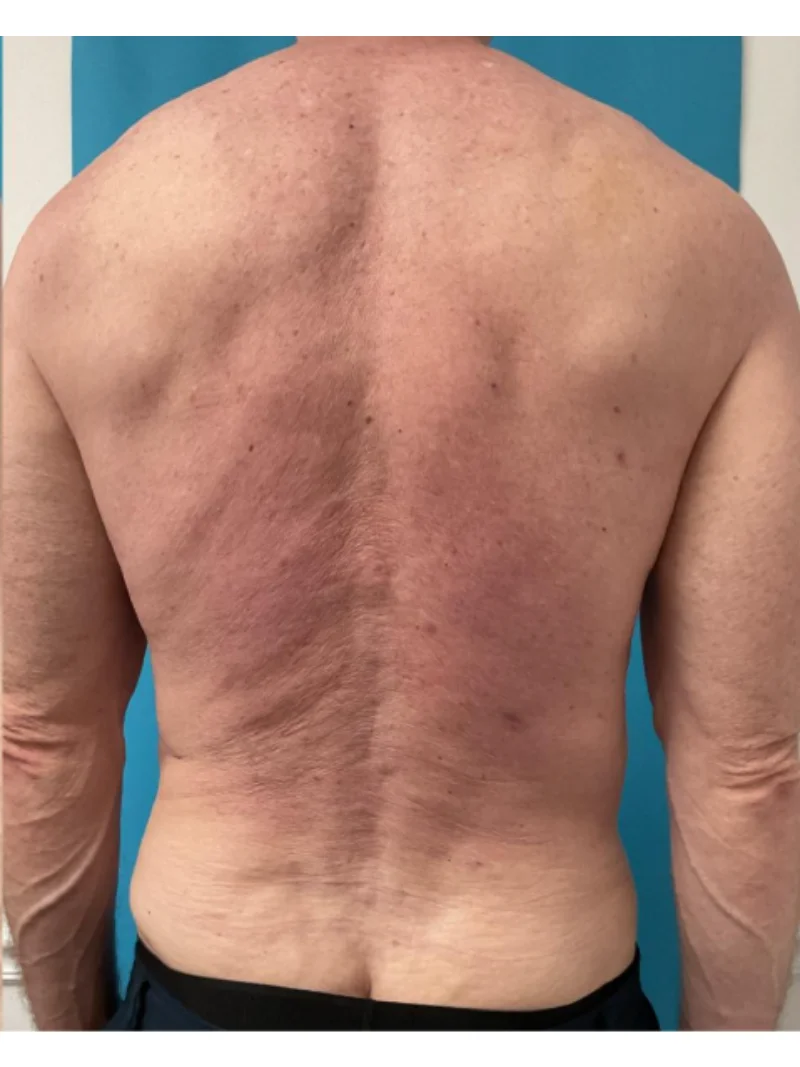 After body contouring 3