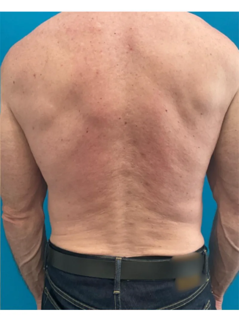Before body contouring 3
