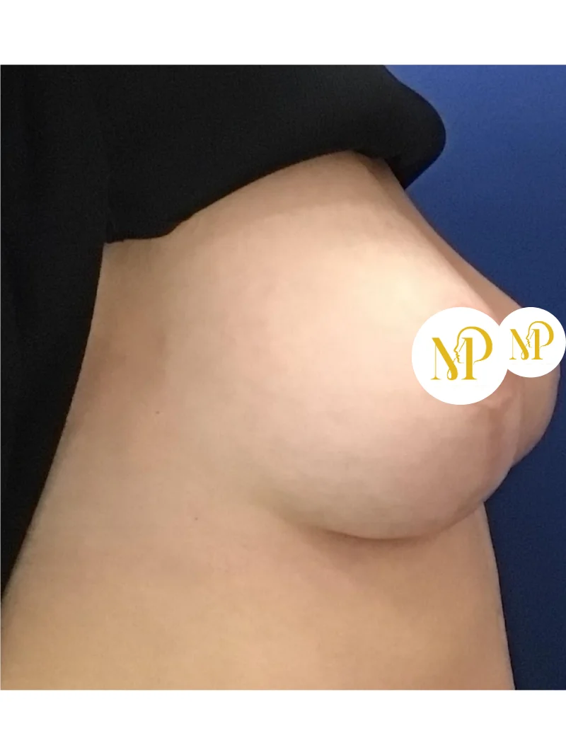 After breast augmentation 3