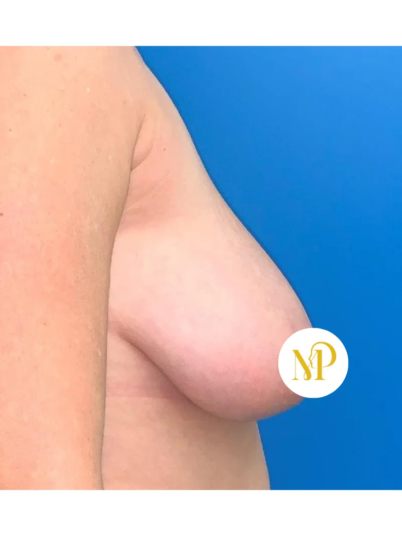 Before breast augmentation 3