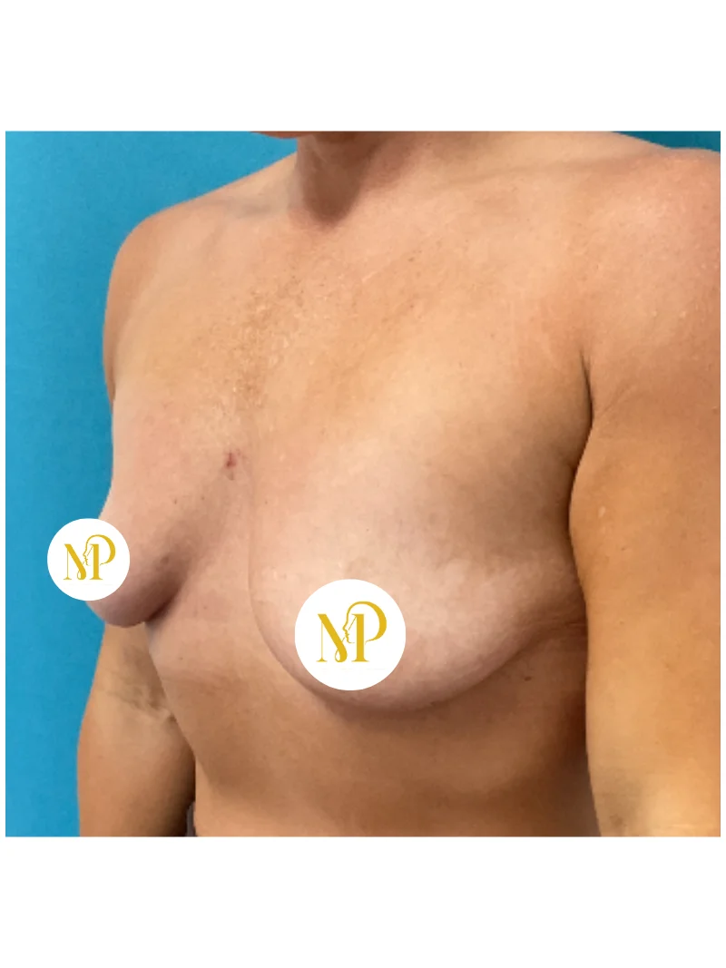 Before breast augmentation 2