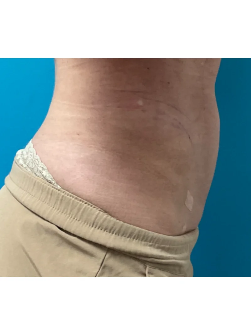 After body contouring 1
