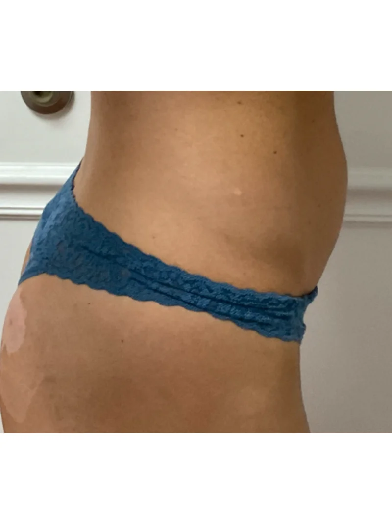 Before body contouring 1