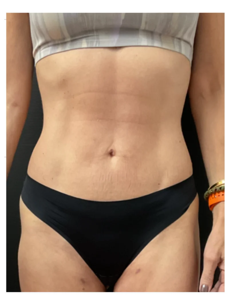 After body contouring 2
