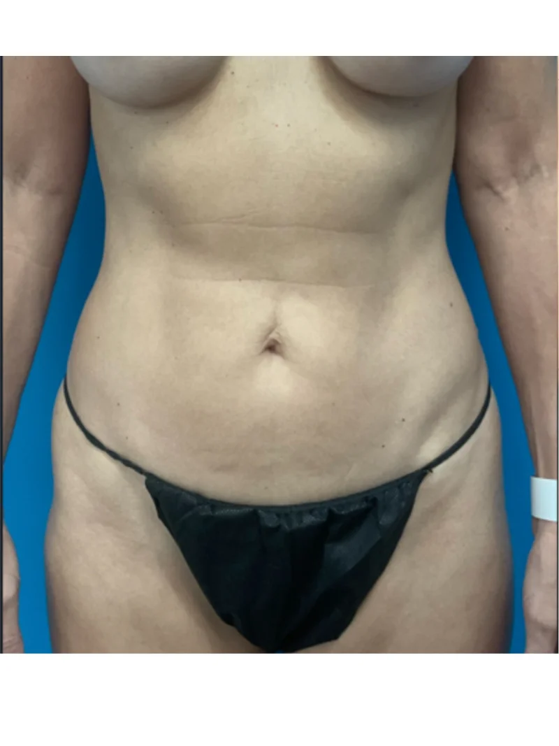 Before body contouring 2