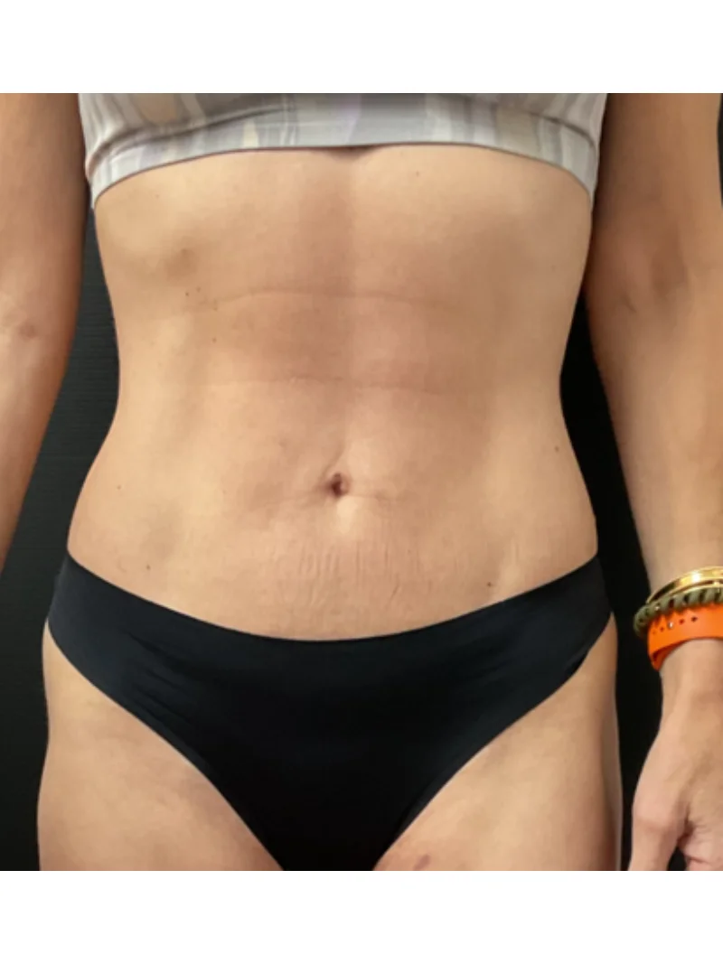 After body contouring 2