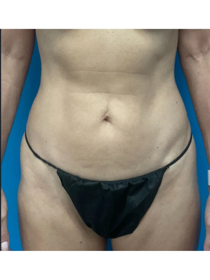 Before body contouring 2