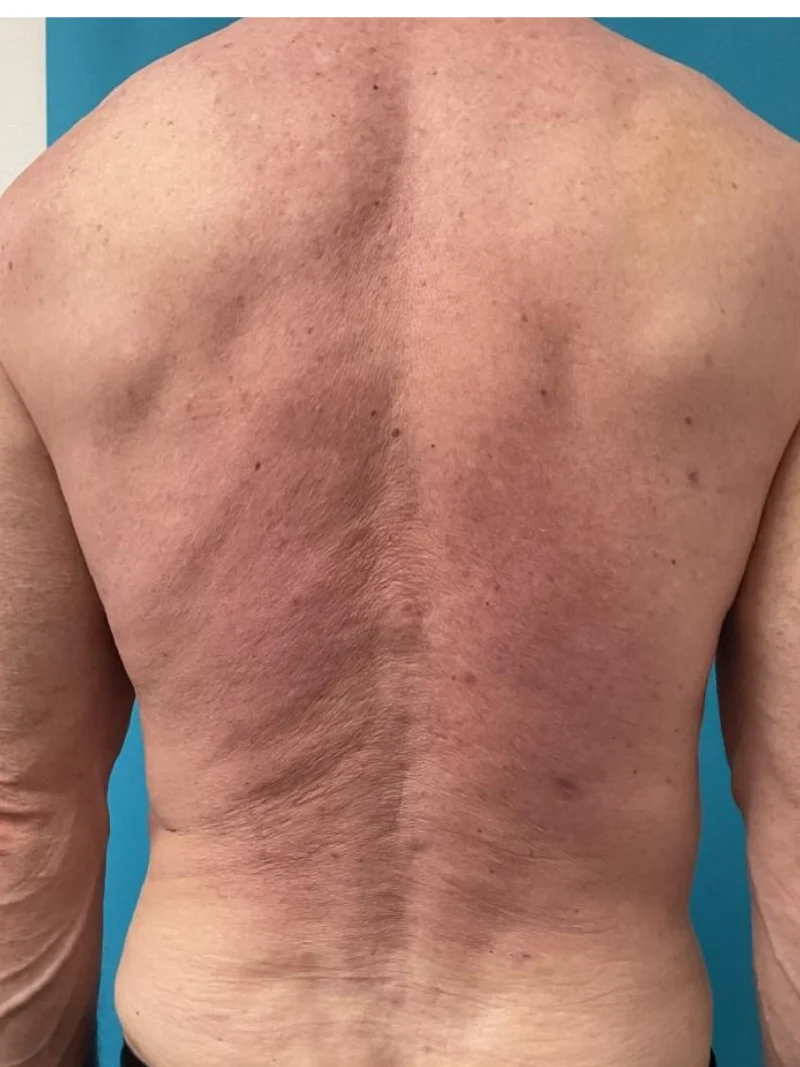 After body contouring 3