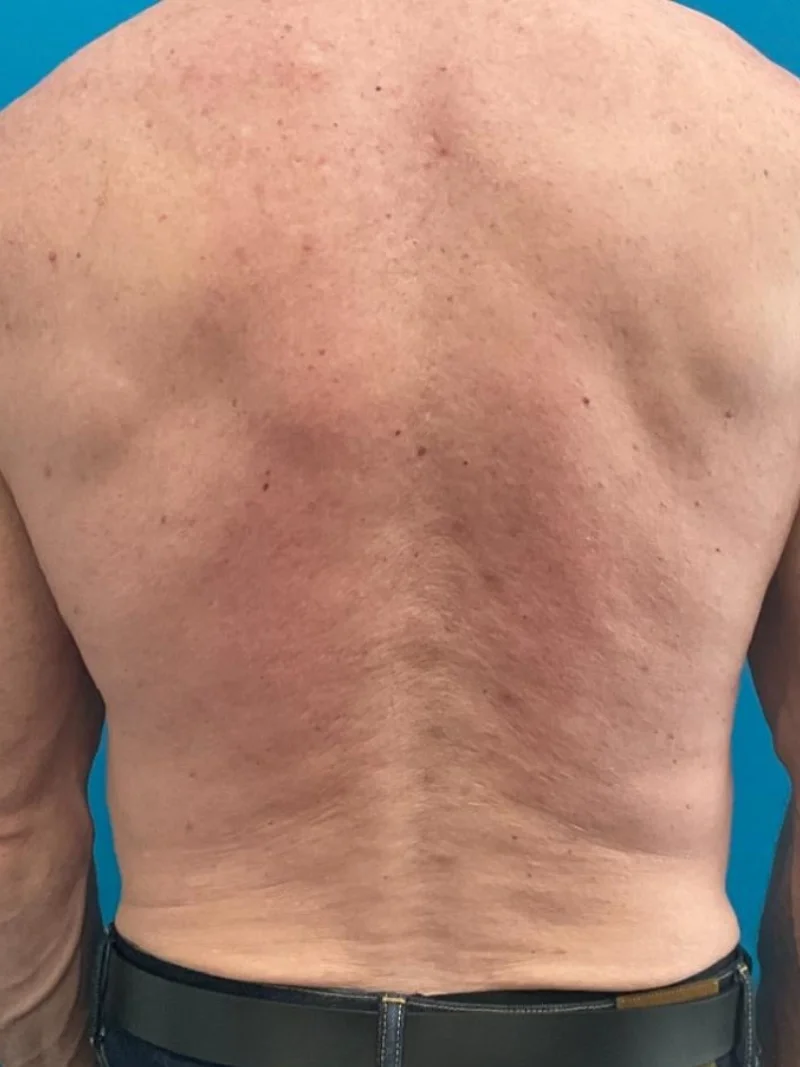 Before body contouring 3