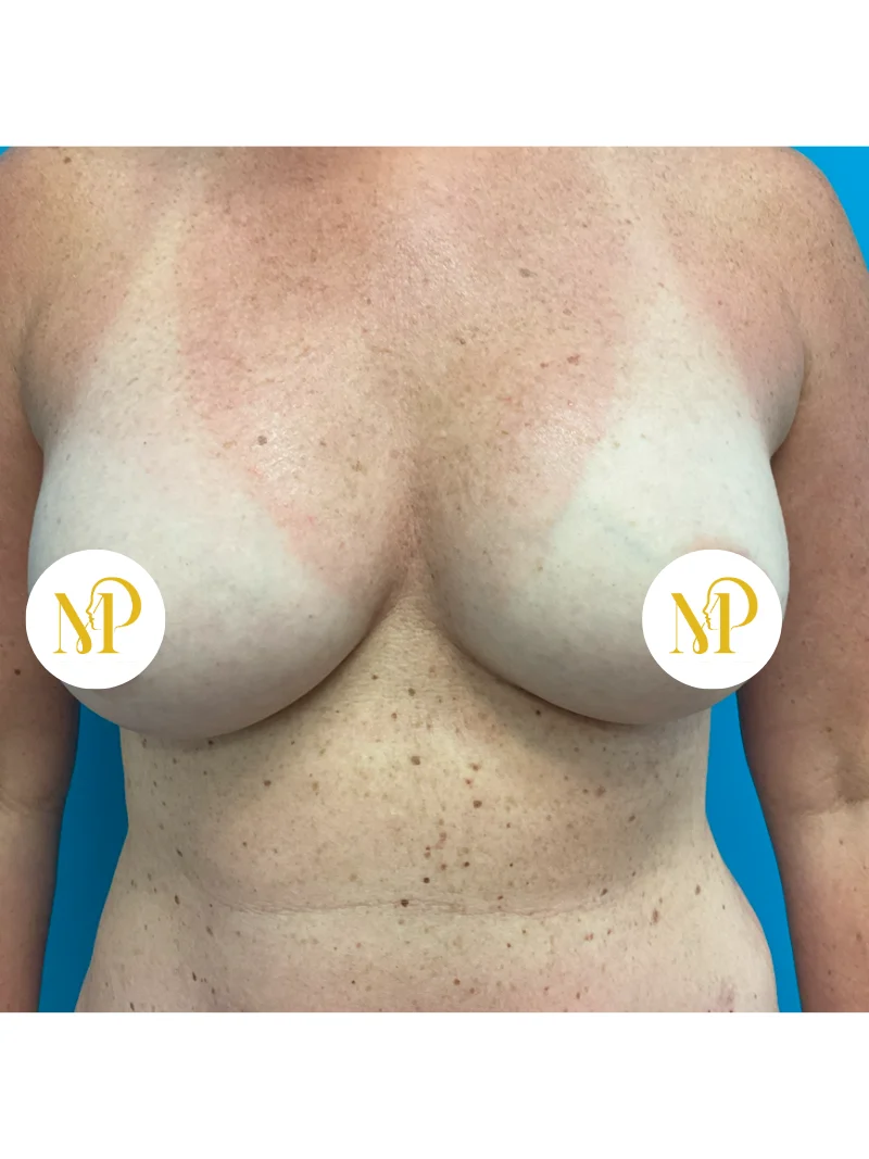 After breast augmentation