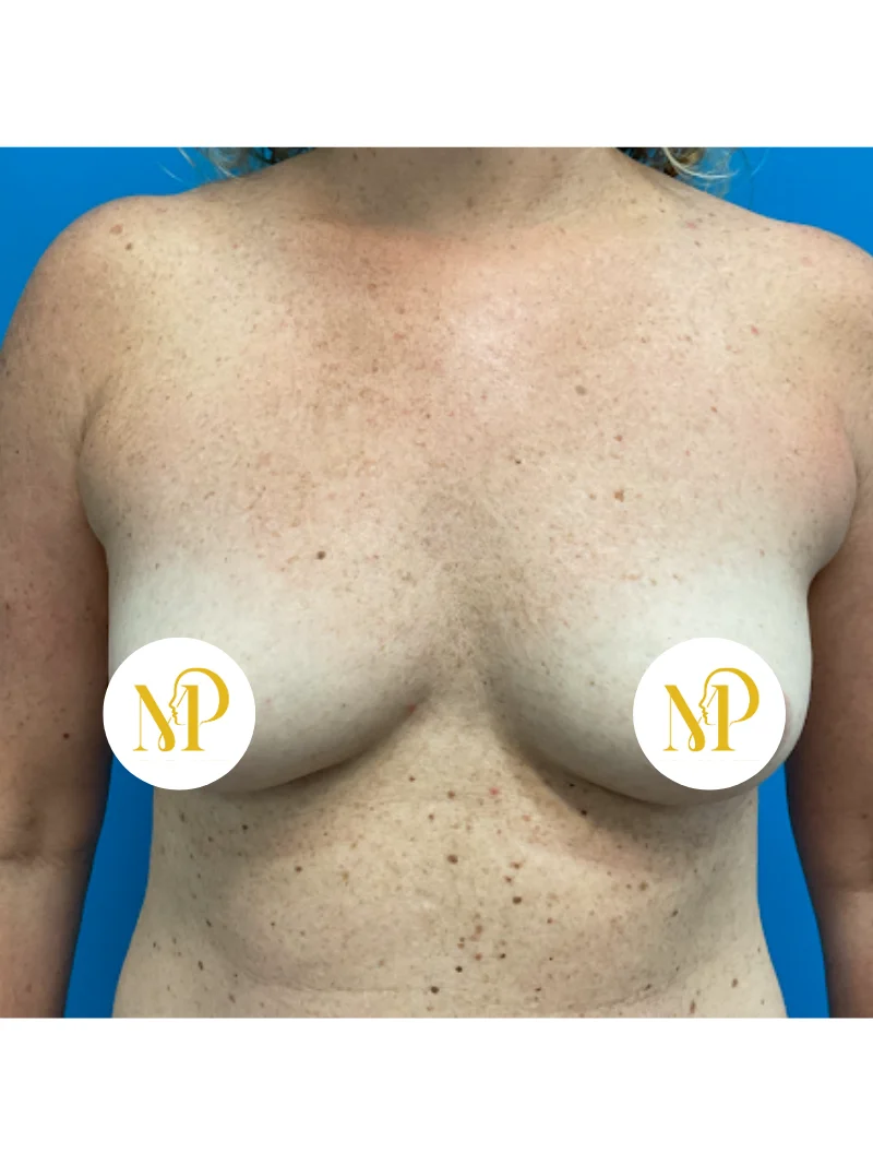 Before breast augmentation