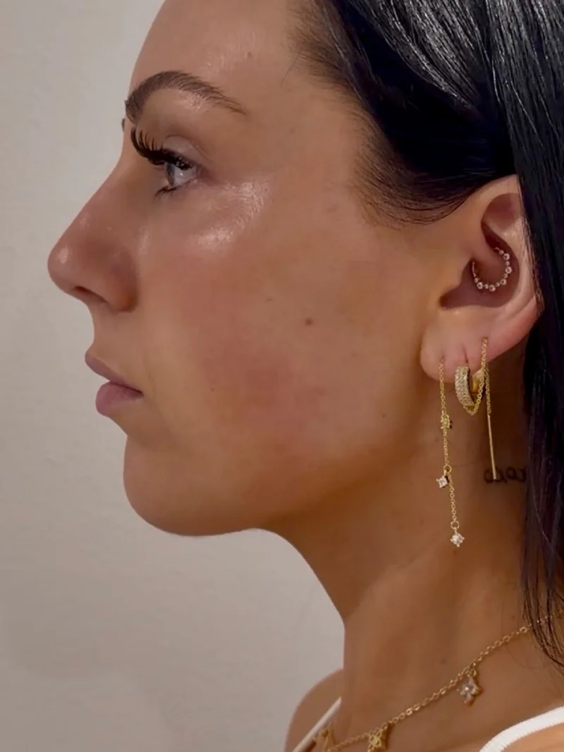 After submental liposuction and FaceTite, profile view
