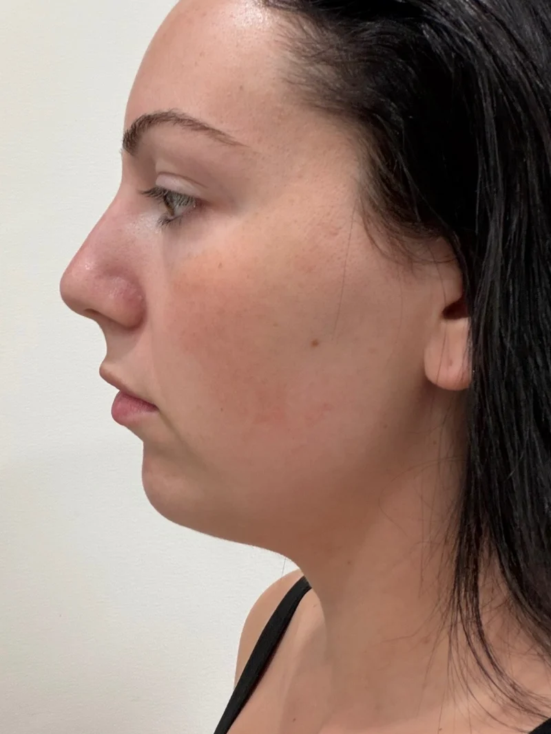 Before submental liposuction and FaceTite, profile view
