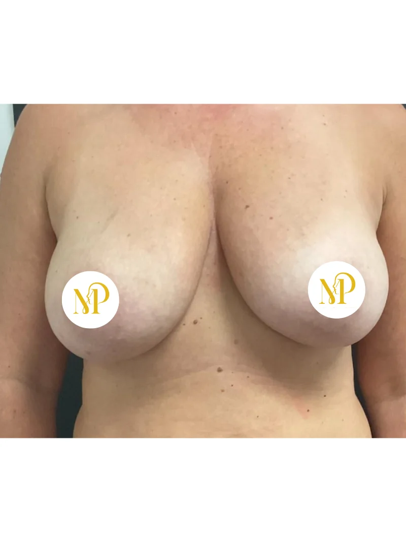 Before breast reduction 2